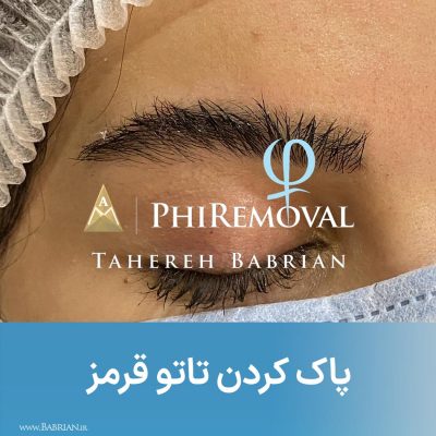 پاک کردن تاتو های بژ رنگ سفید رنگ و کامو در یک جلسه هنر دست خواهران ببریان