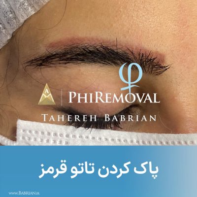 پاک کردن تاتو های بژ رنگ سفید رنگ و کامو در یک جلسه هنر دست خواهران ببریان