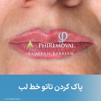 پاک کردن تاتو و رشد مجدد موهای ابرو با خواهران ببریان