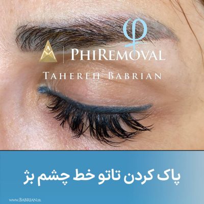 پاک کردن تاتو و رشد مجدد موهای ابرو با خواهران ببریان