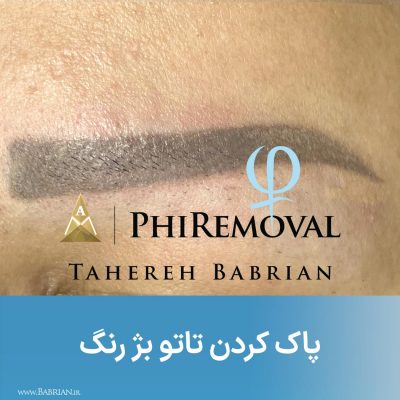 پاک کردن تاتو های بژ رنگ سفید رنگ و کامو در یک جلسه هنر دست خواهران ببریان