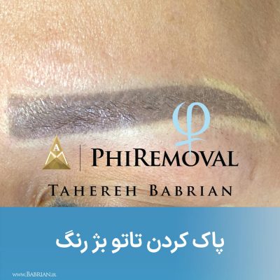 پاک کردن تاتو های بژ رنگ سفید رنگ و کامو در یک جلسه هنر دست خواهران ببریان