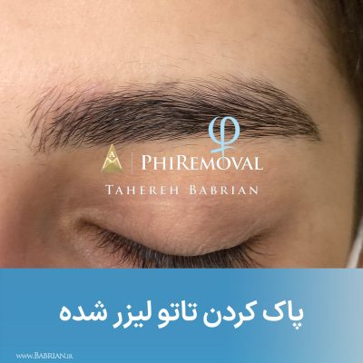 معجزه پاک کردن تاتو های تازه بلید شده