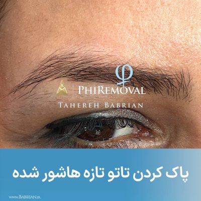 پاک کردن تاتو های بژ رنگ سفید رنگ و کامو در یک جلسه هنر دست خواهران ببریان