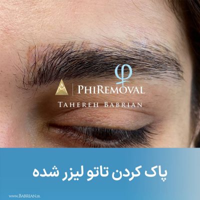 معجزه پاک کردن تاتو های تازه بلید شده