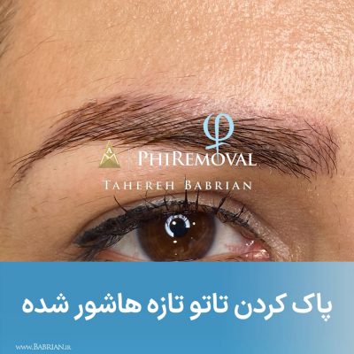 پاک کردن تاتو های بژ رنگ سفید رنگ و کامو در یک جلسه هنر دست خواهران ببریان