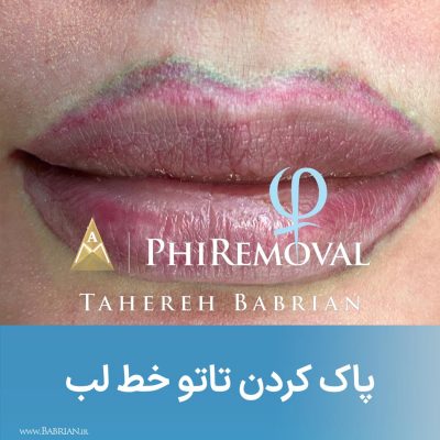 ریموو تاتو ابرو بدن لب خط چشم با خواهران ببریان