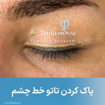 ریموو تاتو ابرو بدن لب خط چشم با خواهران ببریان