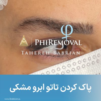 پاک کردن تاتو و رشد مجدد موهای ابرو با خواهران ببریان
