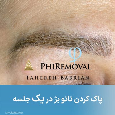 پاک کردن تاتو و رشد مجدد موهای ابرو با خواهران ببریان