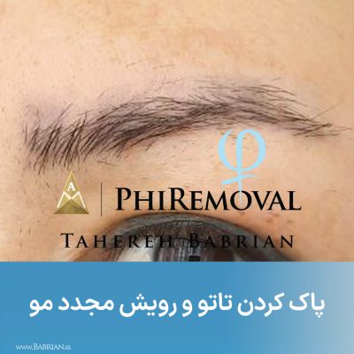 پاک کردن تاتو و رشد مجدد موهای ابرو با خواهران ببریان