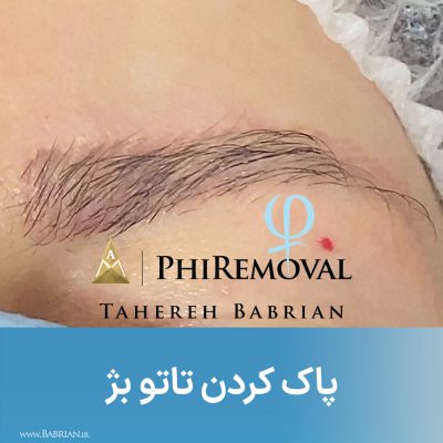 پاک کردن تاتو و رشد مجدد موهای ابرو با خواهران ببریان
