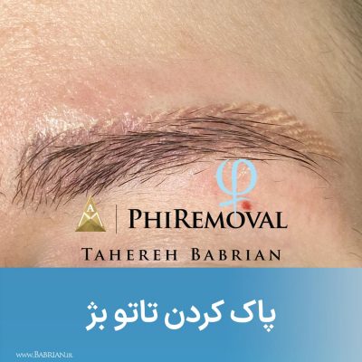 پاک کردن تاتو و رشد مجدد موهای ابرو با خواهران ببریان