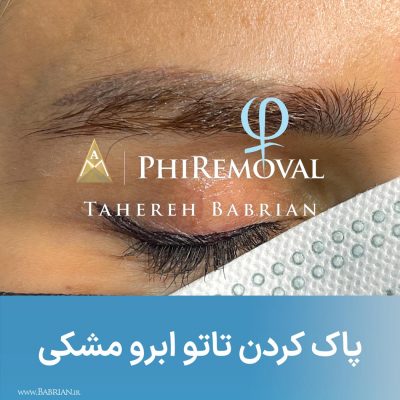 پاک کردن تاتو و رشد مجدد موهای ابرو با خواهران ببریان