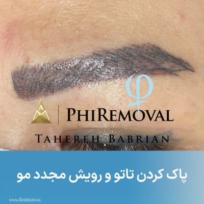 پاک کردن تاتو و رشد مجدد موهای ابرو با خواهران ببریان